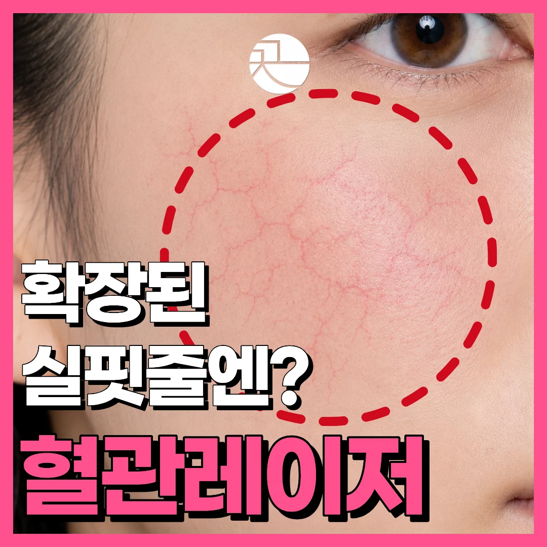 [보기 싫은 확장된 혈관엔?] 실핏줄 혈관레이저