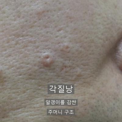피부과비립종, 손으로 짜면 안 되는 이유와 제거 과정 이미지 2