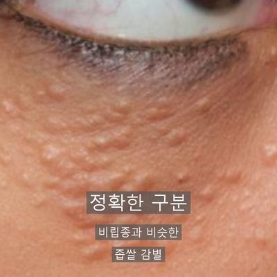 피부과비립종, 손으로 짜면 안 되는 이유와 제거 과정 이미지 4