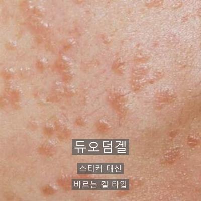 피부과비립종, 손으로 짜면 안 되는 이유와 제거 과정 이미지 7