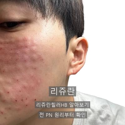 리쥬란힐러HB 알아보신다면? 리쥬란 원리와 추천대상 총정리 이미지 1