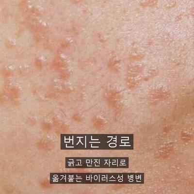 물사마귀치료, 번지기 전에 잡아야 하는 이유 이미지 2
