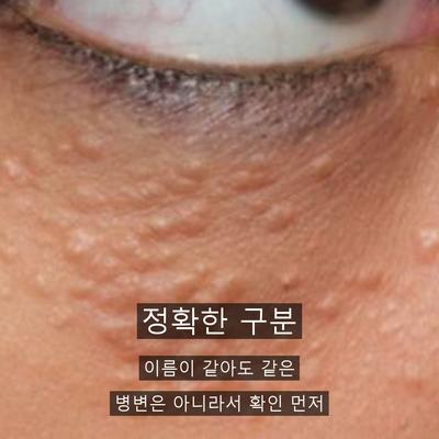 물사마귀치료, 번지기 전에 잡아야 하는 이유 이미지 3