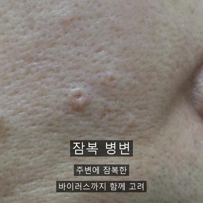 물사마귀치료, 번지기 전에 잡아야 하는 이유 이미지 7
