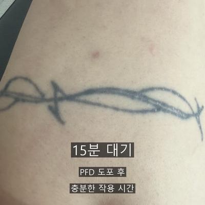 문신제거 치료기관을 고를 때 확인할 3가지 기준 이미지 5