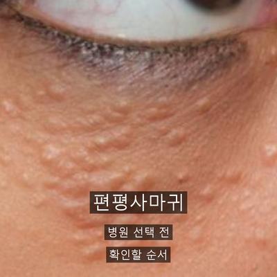 편평사마귀 치료기관을 고를 때 확인할 기준 3가지 이미지 1