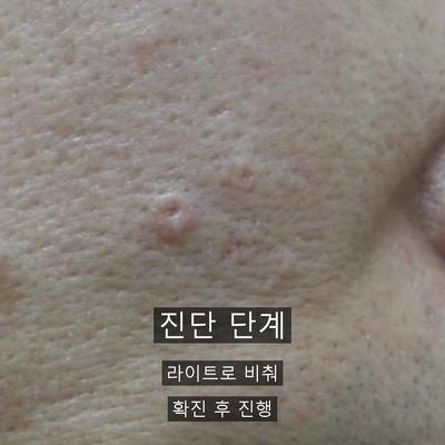 편평사마귀 치료기관을 고를 때 확인할 기준 3가지 이미지 3