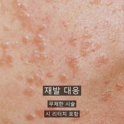 편평사마귀 치료기관을 고를 때 확인할 기준 3가지 이미지 6