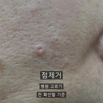 점제거 병원 고를 때 확인할 3가지 기준, 진단부터 사후관리까지 이미지 1