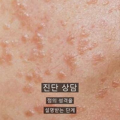 점제거 병원 고를 때 확인할 3가지 기준, 진단부터 사후관리까지 이미지 3