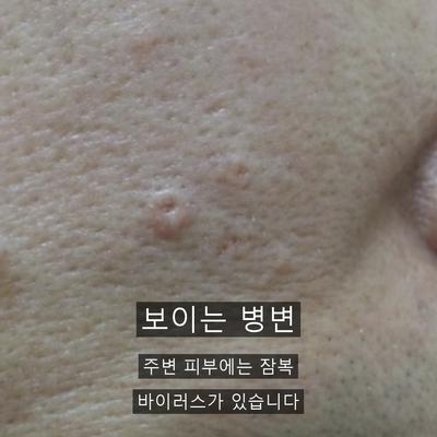 편평사마귀피부과, 집에서 안 되는 이유와 병원 치료의 차이 이미지 3