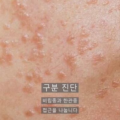 비립종피부과, 재발을 줄이는 제거 방법과 관리 포인트 이미지 2