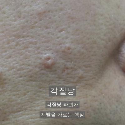 비립종피부과, 재발을 줄이는 제거 방법과 관리 포인트 이미지 3