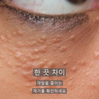 비립종피부과, 재발을 줄이는 제거 방법과 관리 포인트 이미지 9