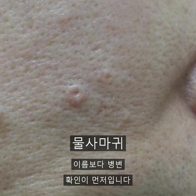 물사마귀없애는법, 집에서 안 되는 이유와 병원 치료의 차이 이미지 1