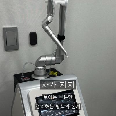 물사마귀없애는법, 집에서 안 되는 이유와 병원 치료의 차이 이미지 3