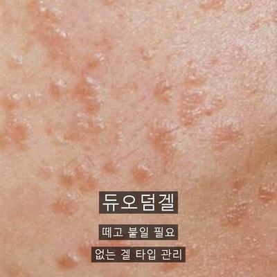 물사마귀없애는법, 집에서 안 되는 이유와 병원 치료의 차이 이미지 7