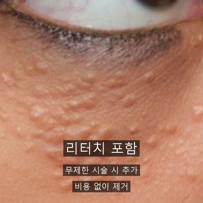 물사마귀없애는법, 집에서 안 되는 이유와 병원 치료의 차이 이미지 8
