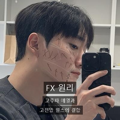 인모드FORMA, 인모드FX와 차이 총정리 이미지 2