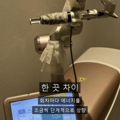 등색소침착, 레이저토닝으로 어떻게 개선할까? 이미지 9