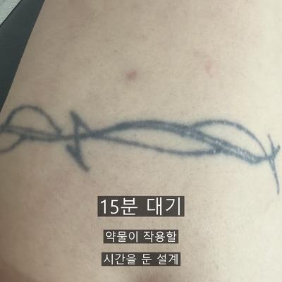 문신제거 치료기관을 고를 때 확인할 기준 이미지 5