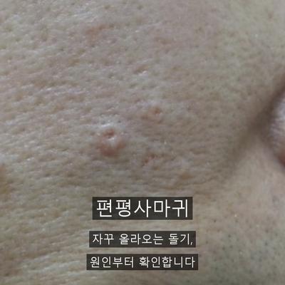 편평사마귀재발, 자꾸 다시 올라오는 이유와 관리법 이미지 1