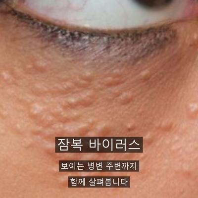 편평사마귀재발, 자꾸 다시 올라오는 이유와 관리법 이미지 2