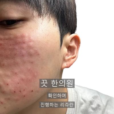 리쥬란 치료기관을 고를 때 확인할 기준 3가지 이미지 8