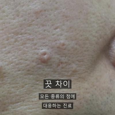 점제거 치료기관을 고를 때 확인할 기준, 진단부터 사후관리까지 이미지 8