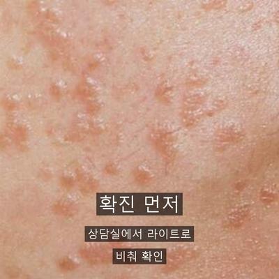 편평사마귀 치료기관을 고를 때 확인할 기준 이미지 2