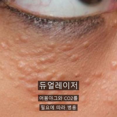 편평사마귀 치료기관을 고를 때 확인할 기준 이미지 5