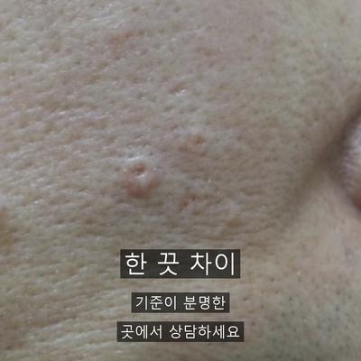 편평사마귀 치료기관을 고를 때 확인할 기준 이미지 9