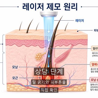 레이저제모 병원 선택, 상담과 설계와 마무리에서 확인할 3가지 기준 이미지 2