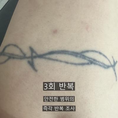 문신제거 병원 선택, 상담·시술 설계·사후 관리에서 확인할 기준 이미지 8