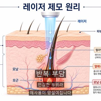 항문제모크림, 자극 때문에 반복이 어려운 이유와 레이저제모 차이 이미지 3