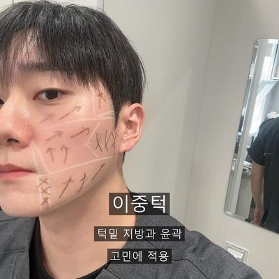 보톡스피부과 찾으신다면? 인모드FX와 목적 차이 정리 이미지 6