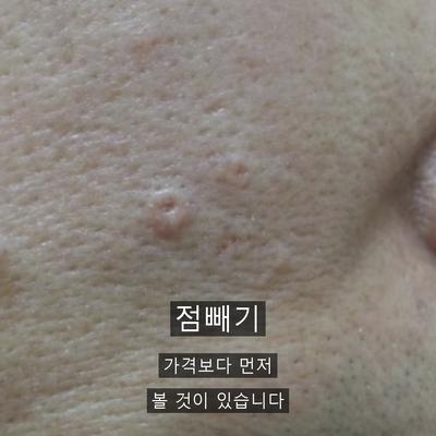 CO2레이저가격보다 점빼기에서 먼저 확인할 3가지 이미지 1