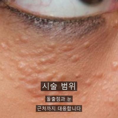 CO2레이저가격보다 점빼기에서 먼저 확인할 3가지 이미지 2