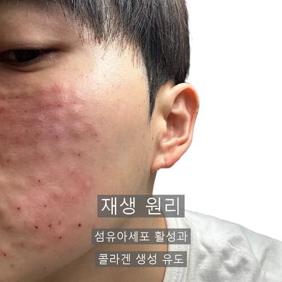 다크서클주사, 리쥬란은 어떤 원리로 도움이 될까? 이미지 5