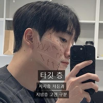 울쎄라인모드, 두 리프팅의 차이와 추천대상 총정리 이미지 4