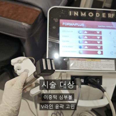 페이스리프팅 종류 총정리, 인모드FX는 어디에 속할까? 이미지 7