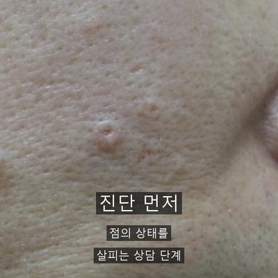 점제거 치료기관을 고를 때 확인할 기준 이미지 2