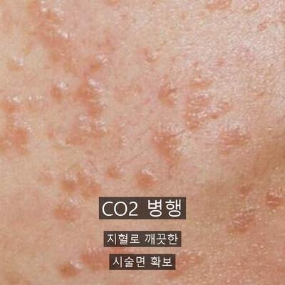 점제거 치료기관을 고를 때 확인할 기준 이미지 6