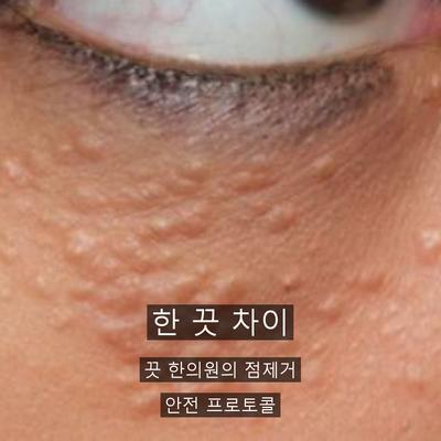 점제거 치료기관을 고를 때 확인할 기준 이미지 9