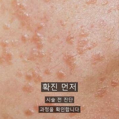 편평사마귀 치료기관을 고를 때 확인할 기준 이미지 3