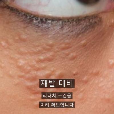 편평사마귀 치료기관을 고를 때 확인할 기준 이미지 7