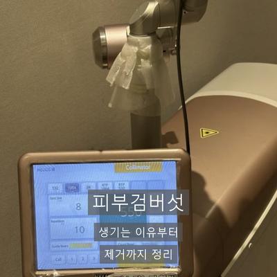 피부검버섯, 생기는 이유와 레이저 제거 과정 정리 이미지 1