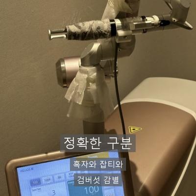 피부검버섯, 생기는 이유와 레이저 제거 과정 정리 이미지 3