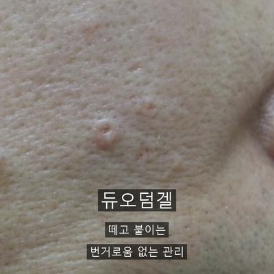 점제거 치료기관을 고를 때 확인할 기준 3가지 이미지 7