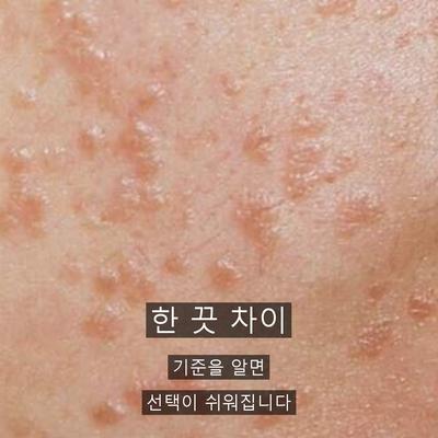 점제거 치료기관을 고를 때 확인할 기준 3가지 이미지 9